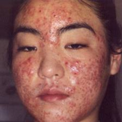 Severe acne pictures Acne Rosacea